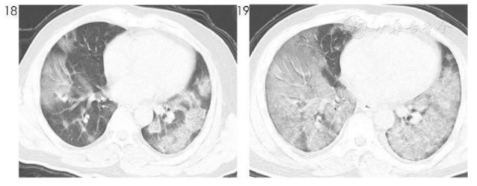 新冠患者肺部图片