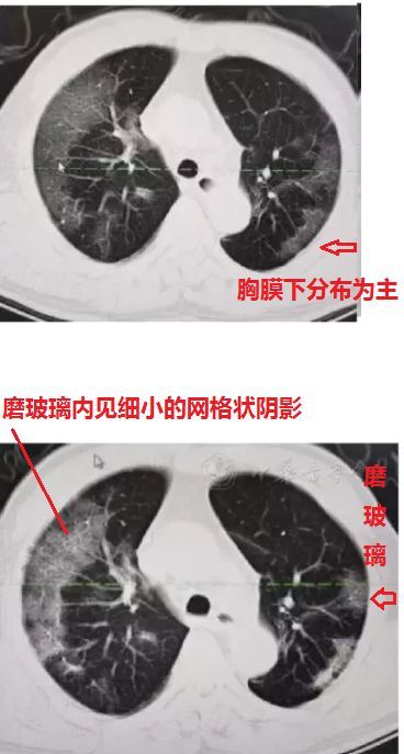 新冠患者肺部的"磨玻璃样阴影"长啥样?看了本文,就会了!_人民号
