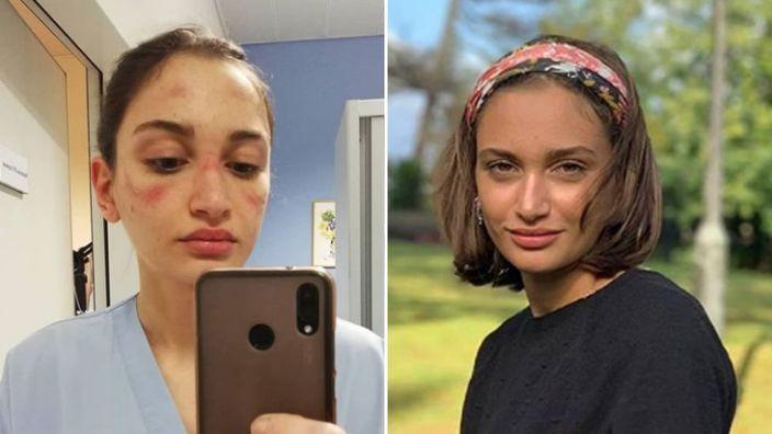 【口罩】意大利护士摘下口罩满脸勒痕 发文称：很累，但不会放弃