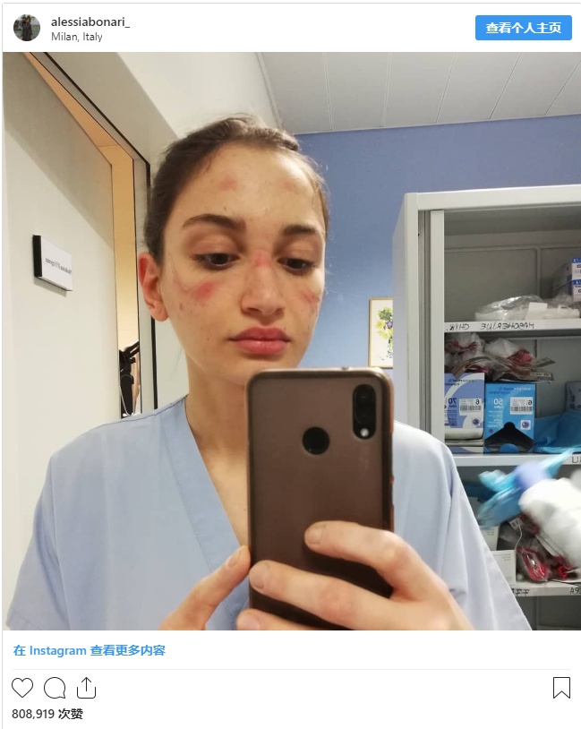 【口罩】意大利护士摘下口罩满脸勒痕 发文称：很累，但不会放弃