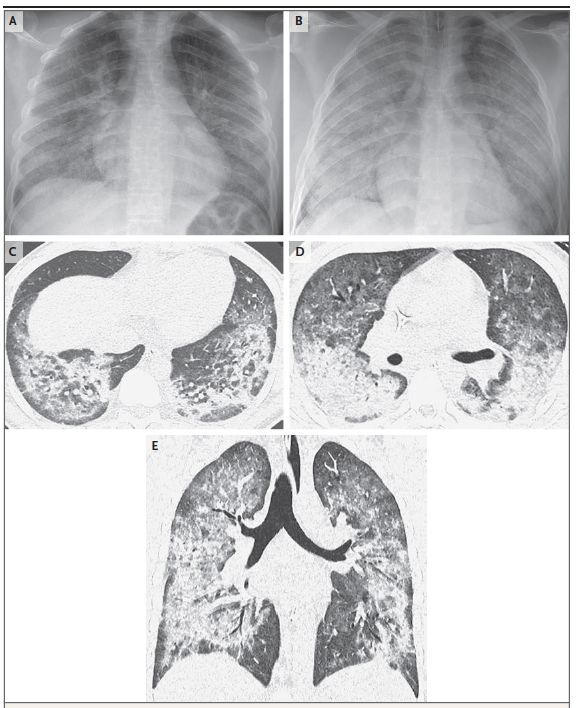 图1:一名17岁患者的胸片以及肺部ct表现为明确病因,临床医生还对其中