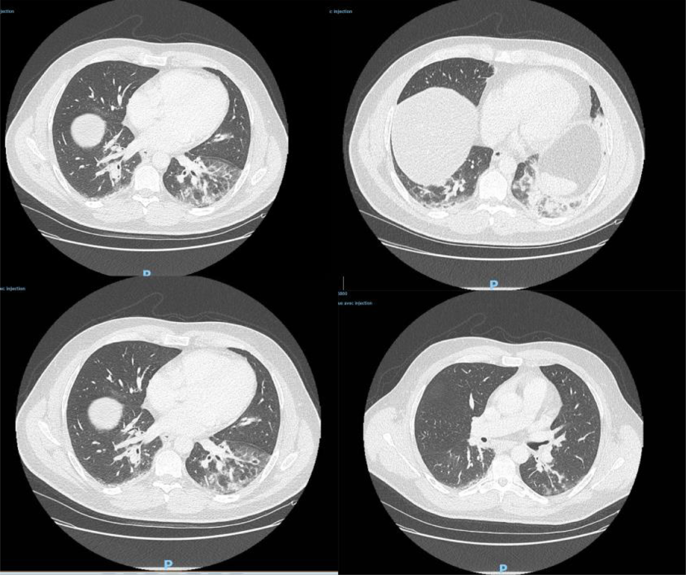 国际证据越来越多!新冠病毒去年底或已在西方国家传播