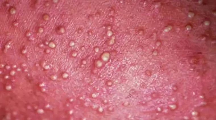 湿疹和痱子分不清儿科医生教你4招轻松区分和护理