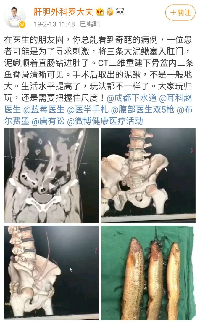 不管什么时候提到直肠异物,大家难免带着猎奇的心态去看待.