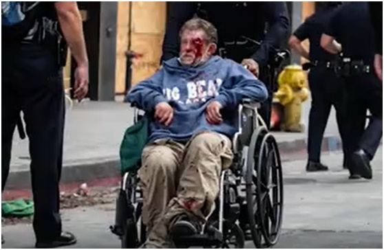 橡皮子弹|满脸是血...美坐轮椅流浪汉遭警方“橡皮子弹”击中，照片触目惊心！