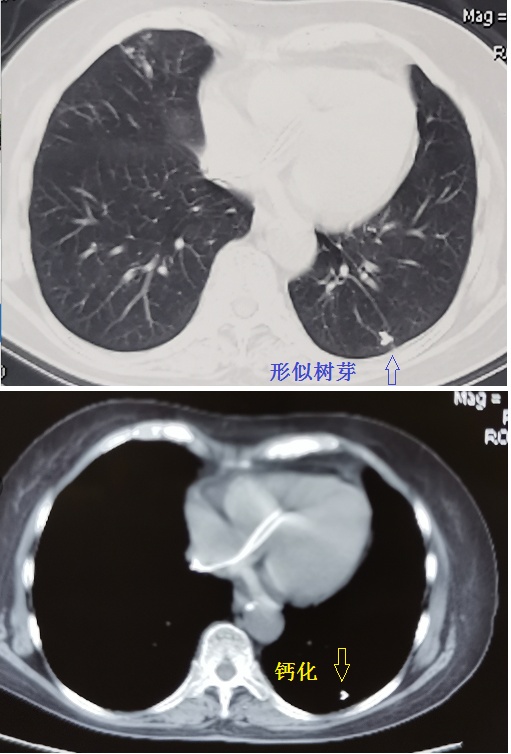 肺部ct基础读片—认识树芽征