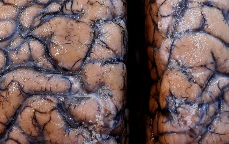 国际|研究称新冠病毒会造成脑损伤 或产生中风、精神疾病