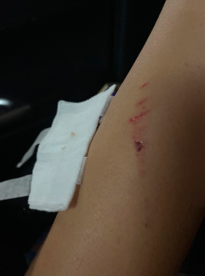 社会|险!精装房浴室玻璃门炸裂,19岁女孩身上多处被扎伤