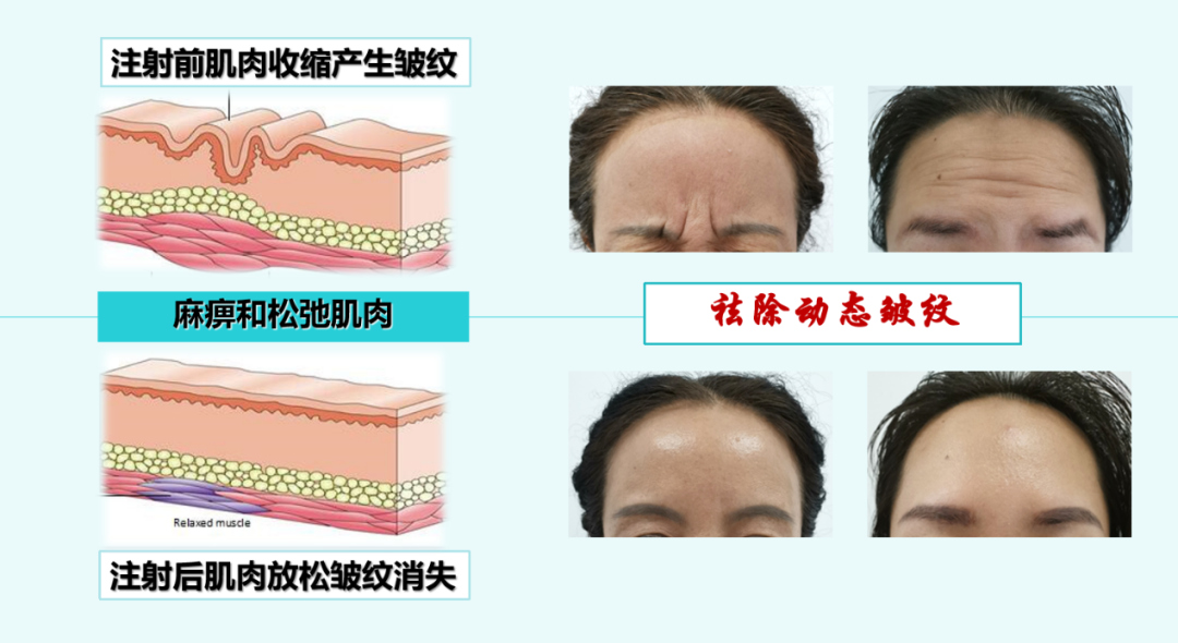 肉毒素|医者名片| 想打美容针？十条肉毒素“大起底”你不可不看！