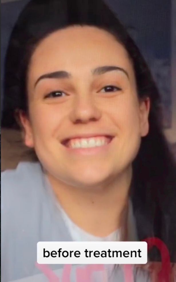 抽脂手术|澳大利亚19岁少女做下巴抽脂手术 拆线后新脸吓坏家人(图)