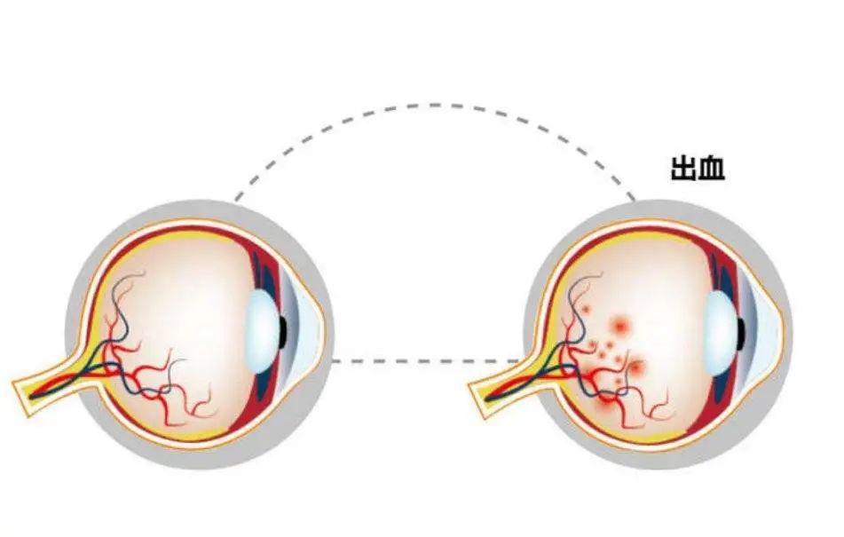 视网膜|有没有想过，我们的眼睛是不完美的？