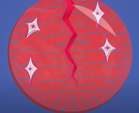 疤痕增生|受伤的时候疼就算了，为什么伤好了还会留下疤？？