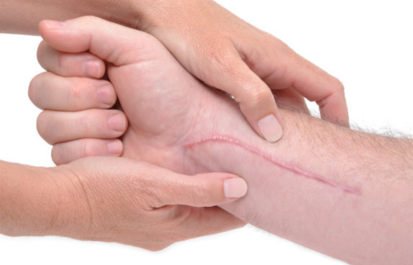 疤痕增生|受伤的时候疼就算了，为什么伤好了还会留下疤？？