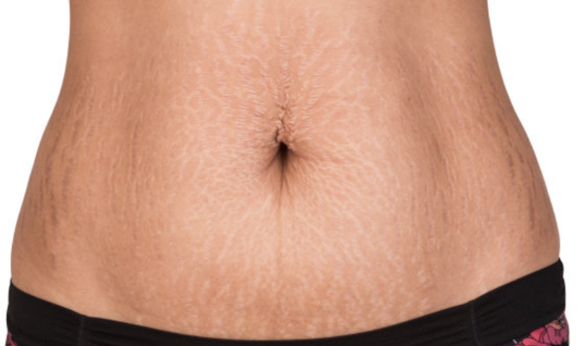 疤痕增生|受伤的时候疼就算了，为什么伤好了还会留下疤？？