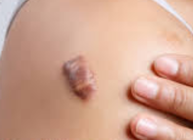 疤痕增生|受伤的时候疼就算了，为什么伤好了还会留下疤？？