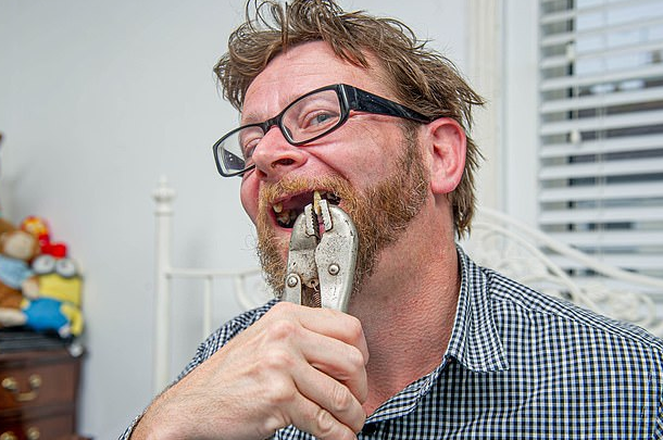 疫情|疫情期间约不到牙医 男子自己用钳子拔了两颗牙