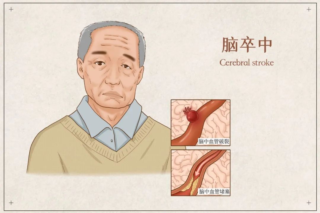 脑卒中|【世界脑卒中日】医体融合，预防卒中