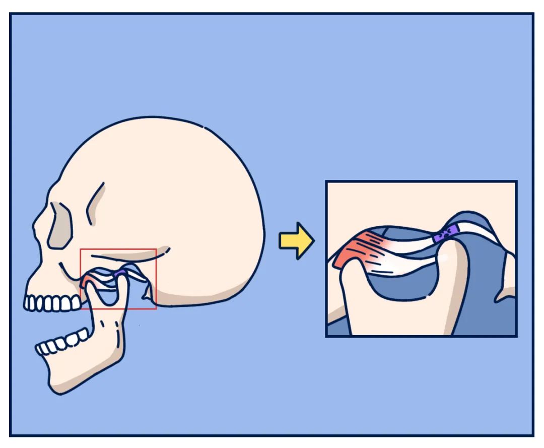 关节弹响|打哈欠的时候,嘴千万别张太大