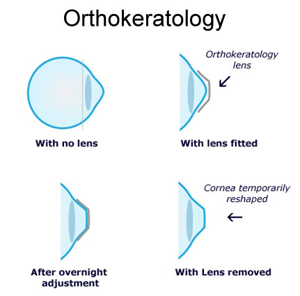 矫正近视，OK镜到底OK不OK?