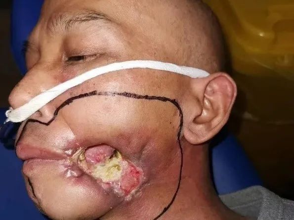 3)图片来源:专家提供更可怕的是,槟榔的致癌性并不止步于口腔癌,咽喉