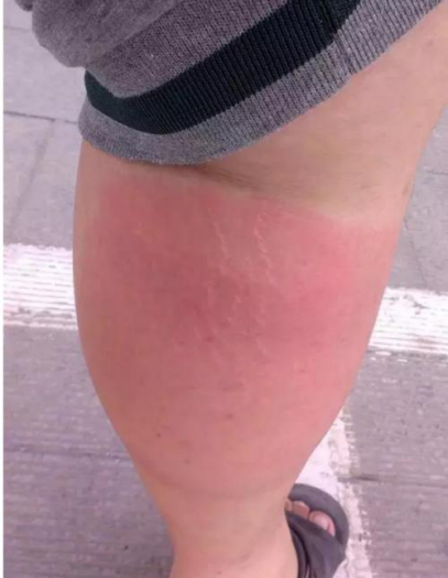 皮肤病|雨后蹚水的人都后悔了......