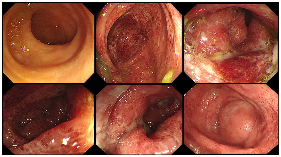 直肠溃疡肠镜图片图片