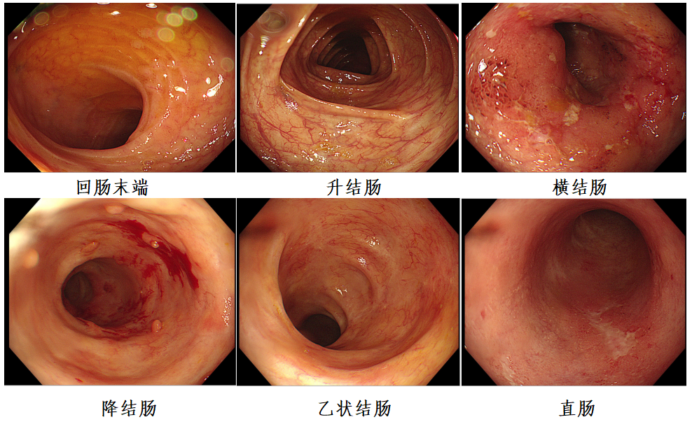 图6 肠镜检查结果