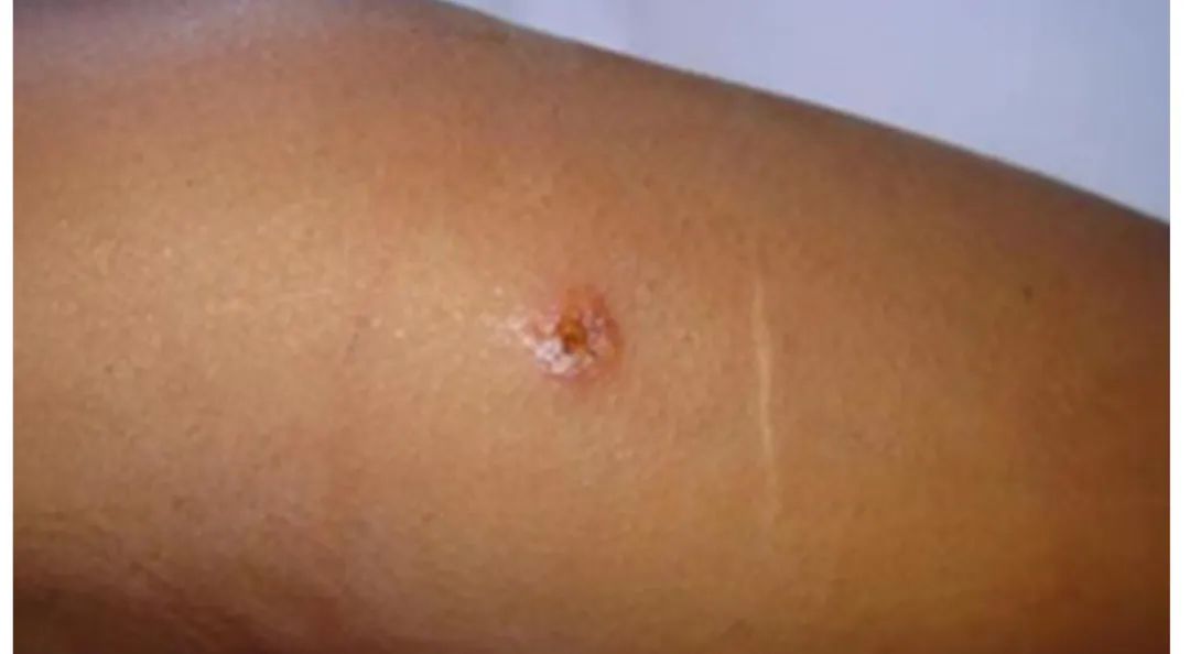 带您走近炭疽的世界