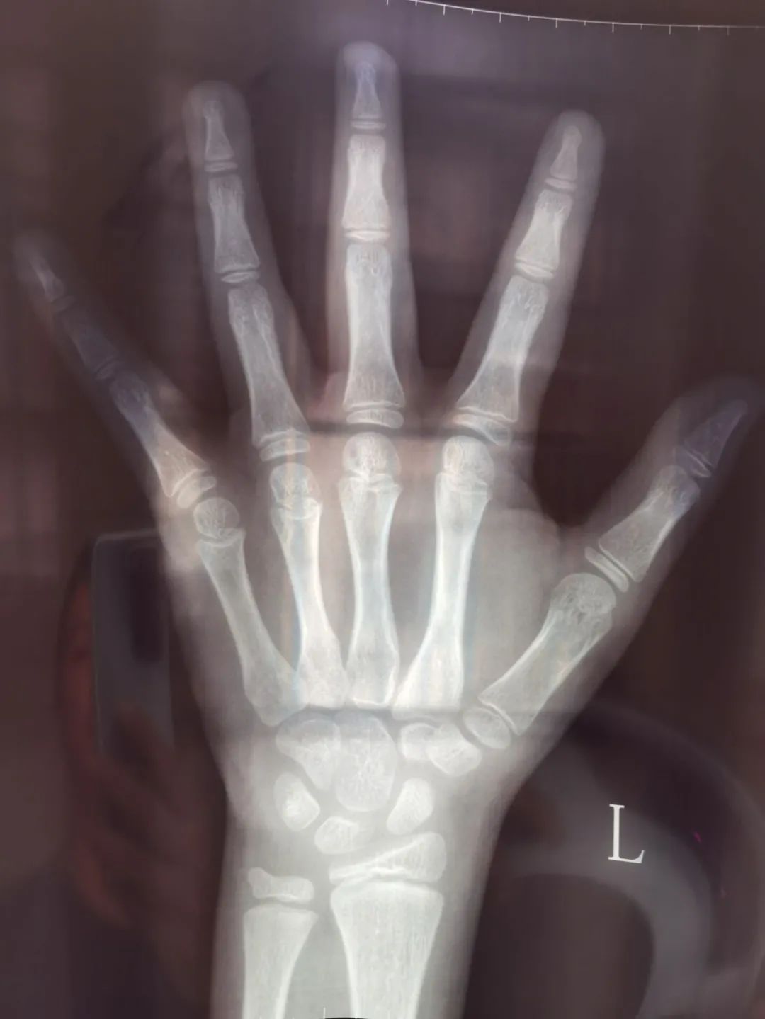 胡思云对自己拎着的那一沓片子和检查结果如数家珍:"这是x光骨龄片,这