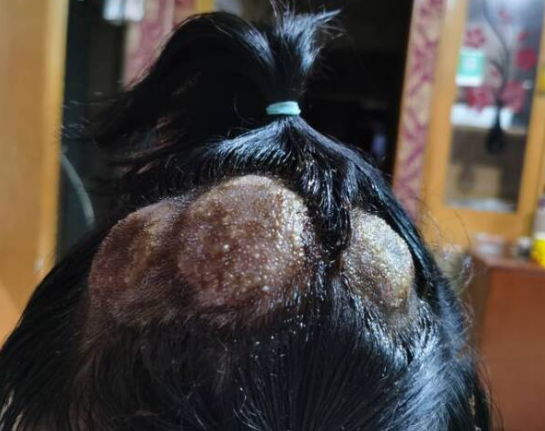 姐弟俩头皮流脓发高烧养宠物的注意了