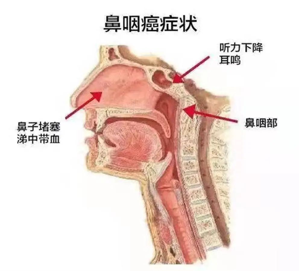 女子因经常吃这个患上了鼻咽癌很多湖南人都爱吃