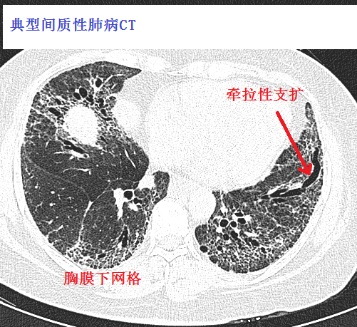 间质性肺炎ct图片特点图片