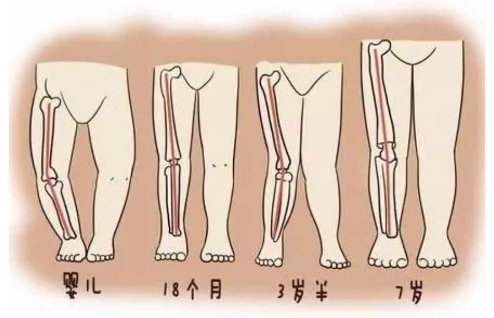 从儿童到老年罗圈腿是病吗