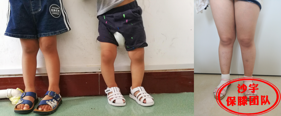 从儿童到老年罗圈腿是病吗