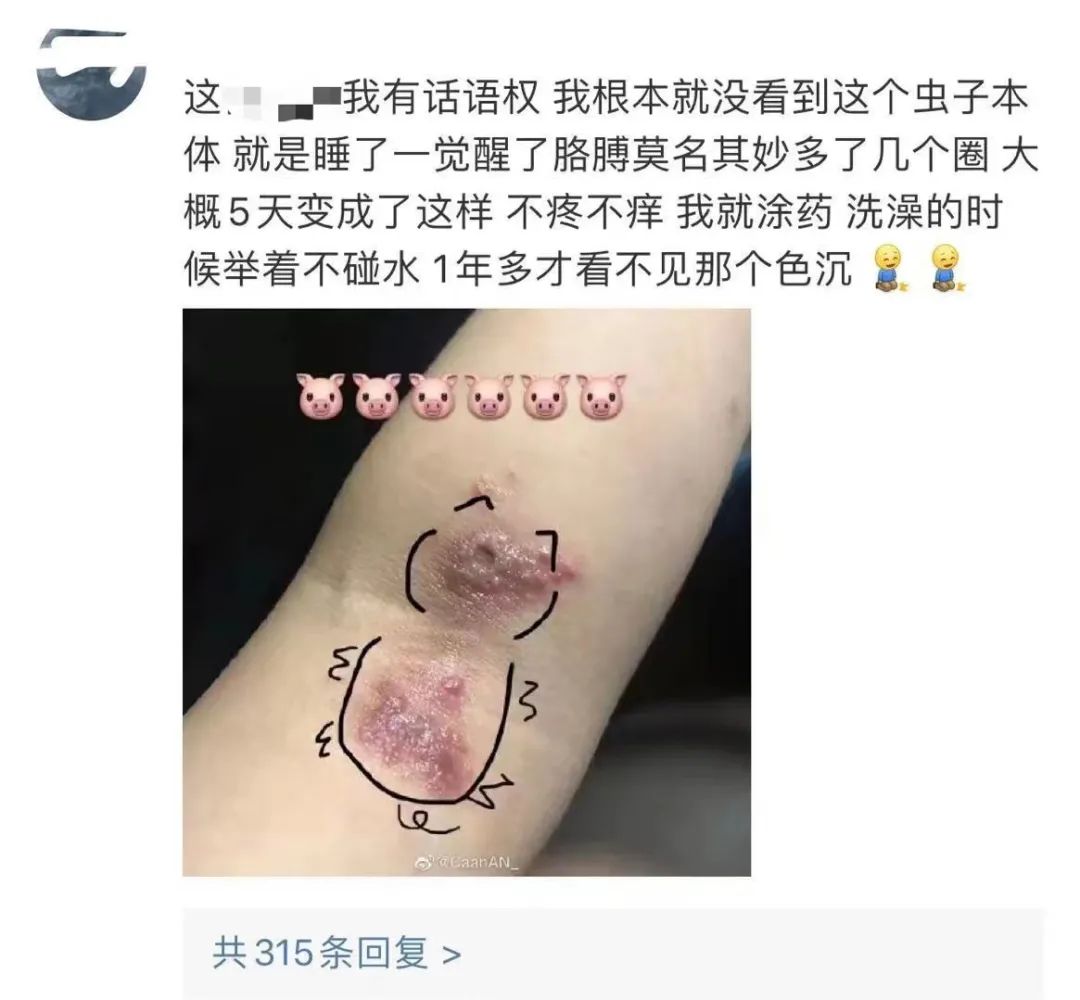 既然隐翅虫这么可怕,那么它落在身上后,我们到底应该怎样做呢?