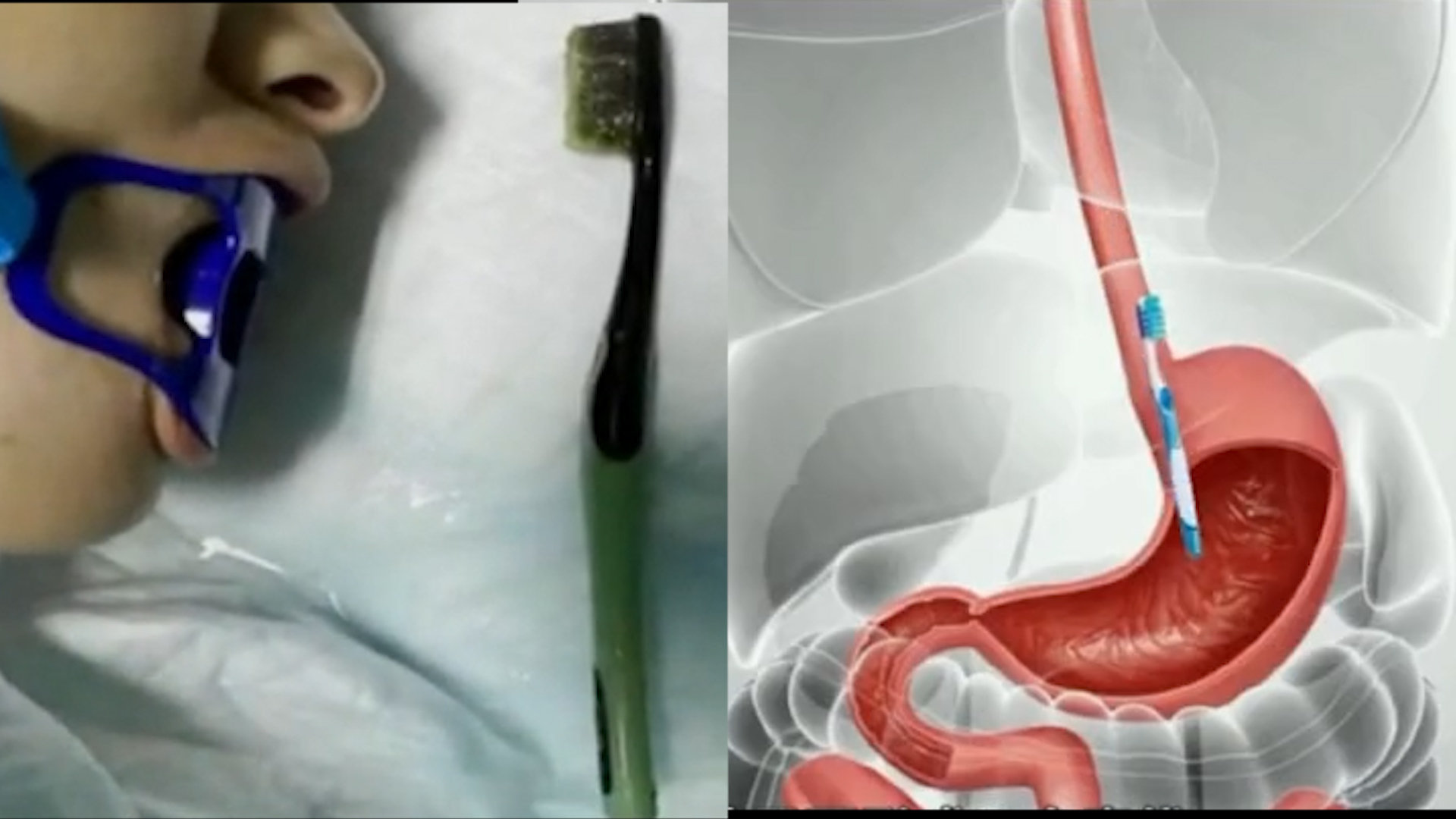 匪夷所思女子刷牙时牙刷滑进胃里