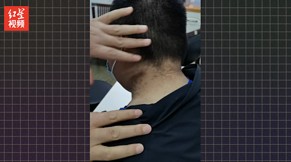 你知道有些肥胖人士的脖子洗不干净吗医生黑棘皮病减重可缓解
