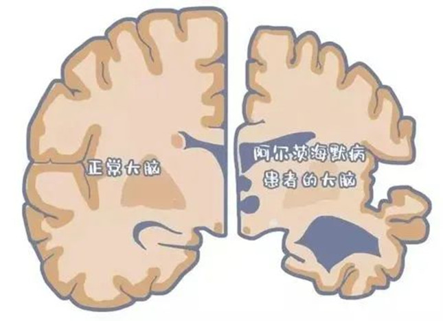 国际首创检测技术!浙大一院抽取少量血就能诊断阿尔茨海默病(ad)_人民