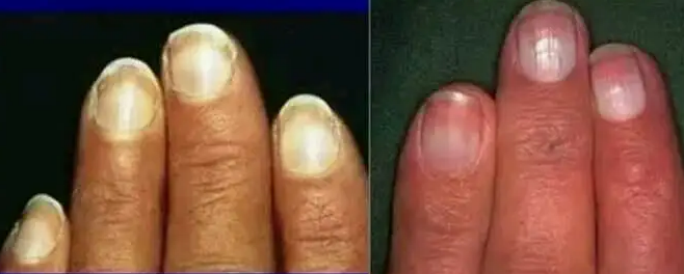 儿科医生教你通过观察孩子的手指判断孩子是否健康