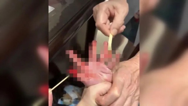 在靖江市某小区景观池发现的鳄雀鳝咬伤了一名男孩。微信公众号“今靖江” 图。