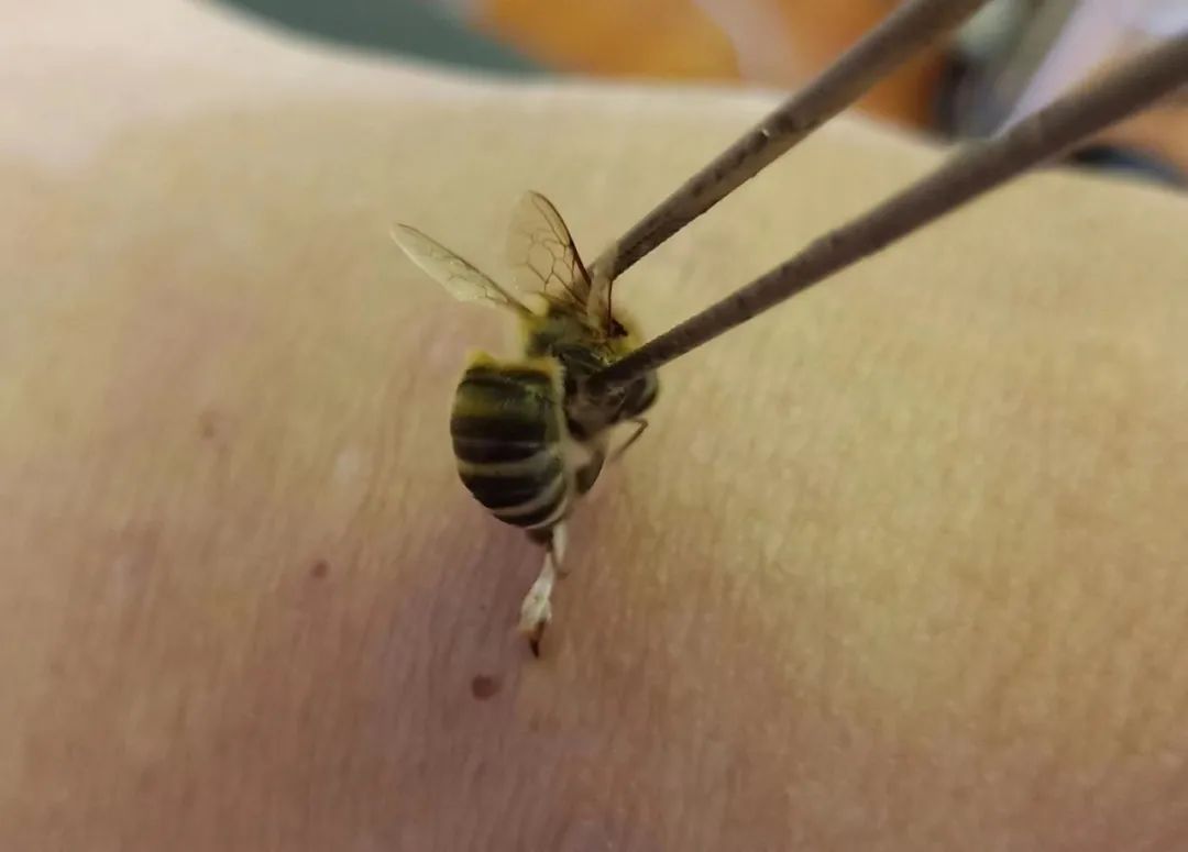 我为群众办实事 蜂针疗法解民忧