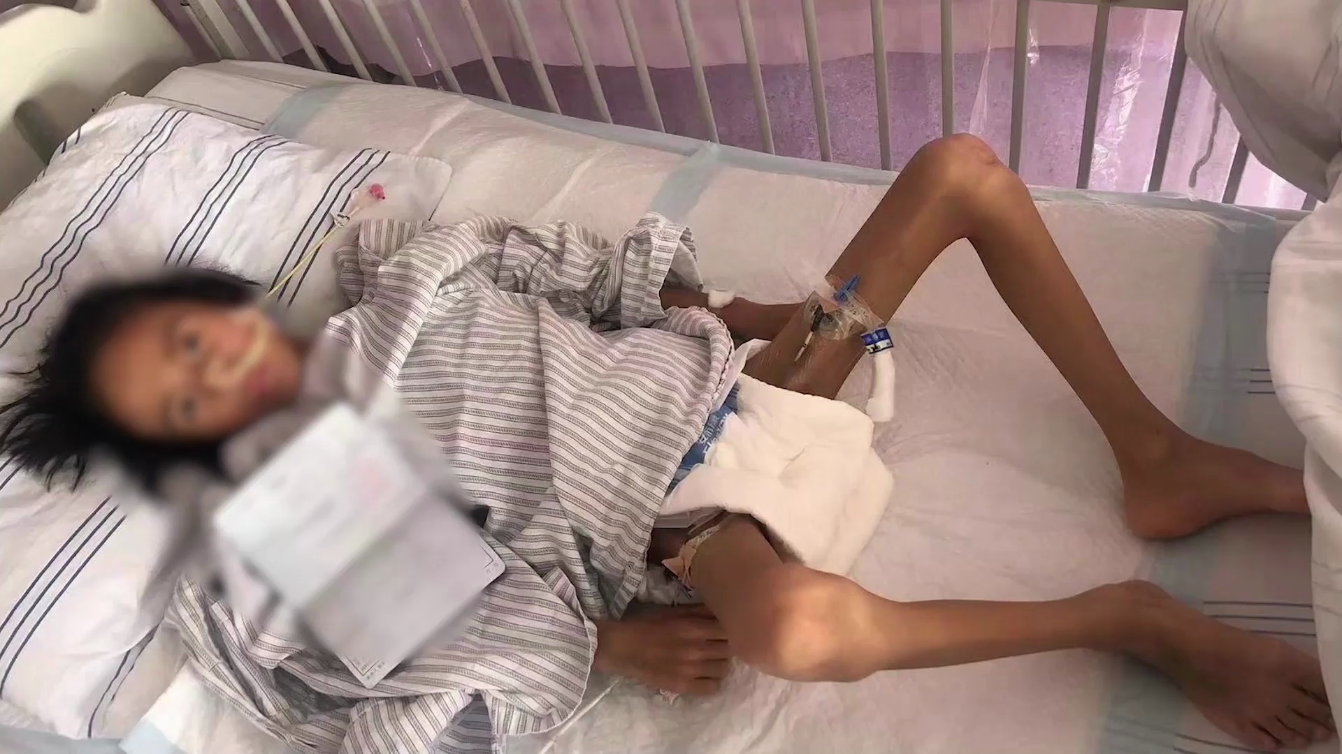 7岁噬血症女童瘦至脱相不足14公斤