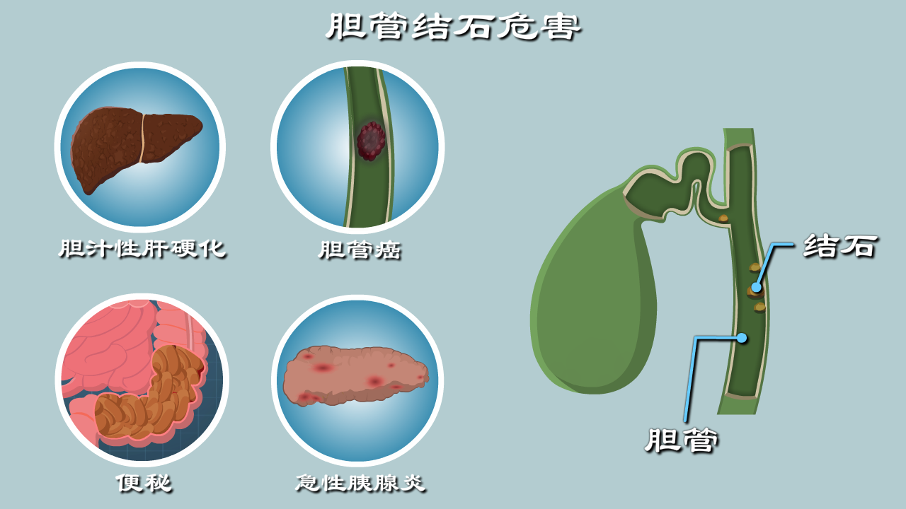 膽管結石是怎麼搞壞你的肝膽腸胰的畫得太棒了