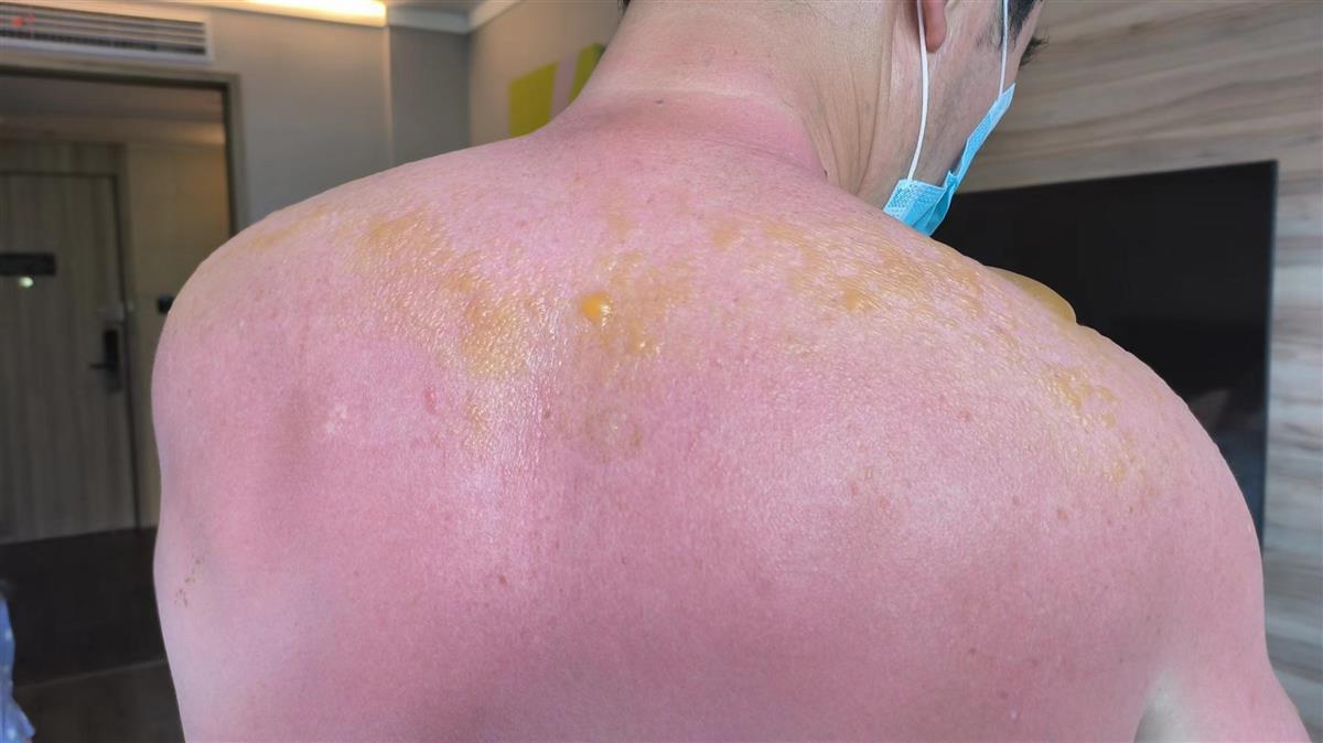 戏水3小时全家被晒伤医生水中紫外线剂量比陆地上更大