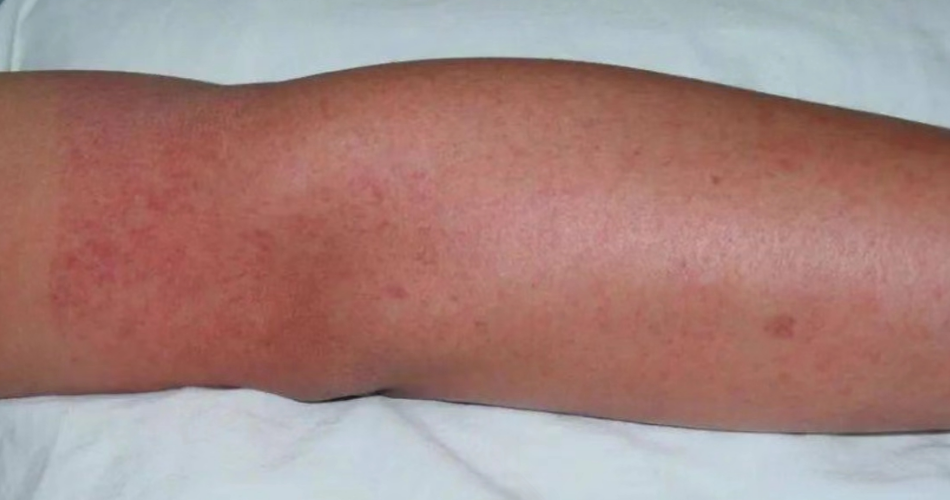 登革热主要症状和体征有哪些?