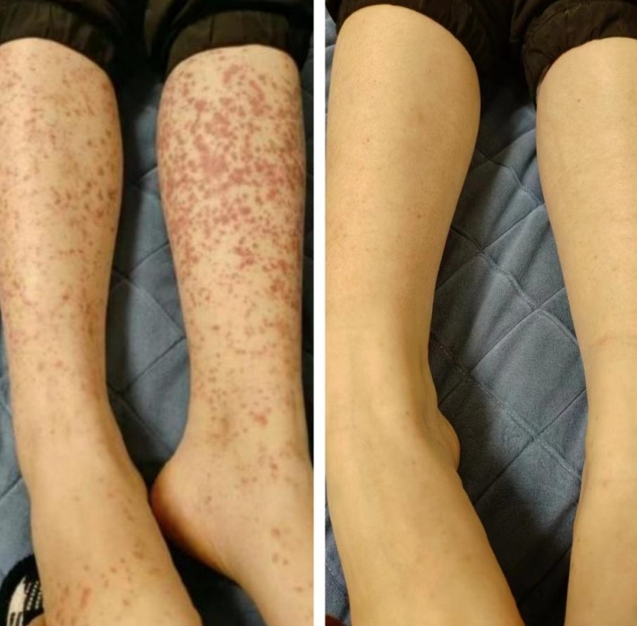 吃了一顿火锅后11岁女孩被确诊过敏性紫癜中药调治后好转