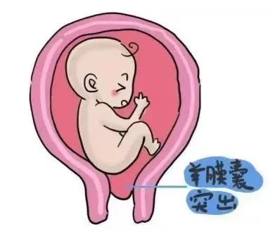 住院4次保胎131天宮頸環扎術助孕媽喜迎新生命