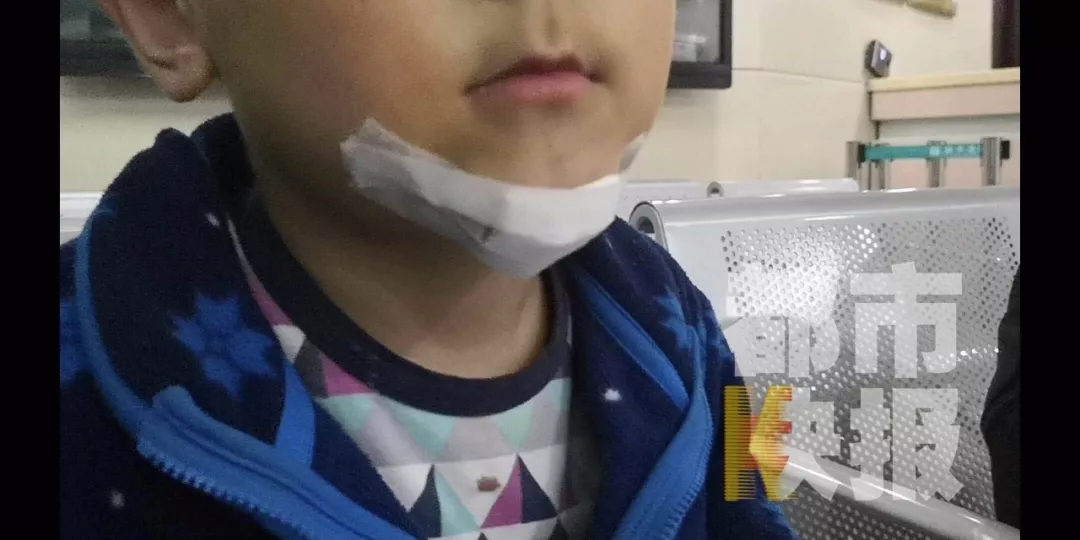 西安8岁男童学抖音害弟弟下巴缝10针,家长怒