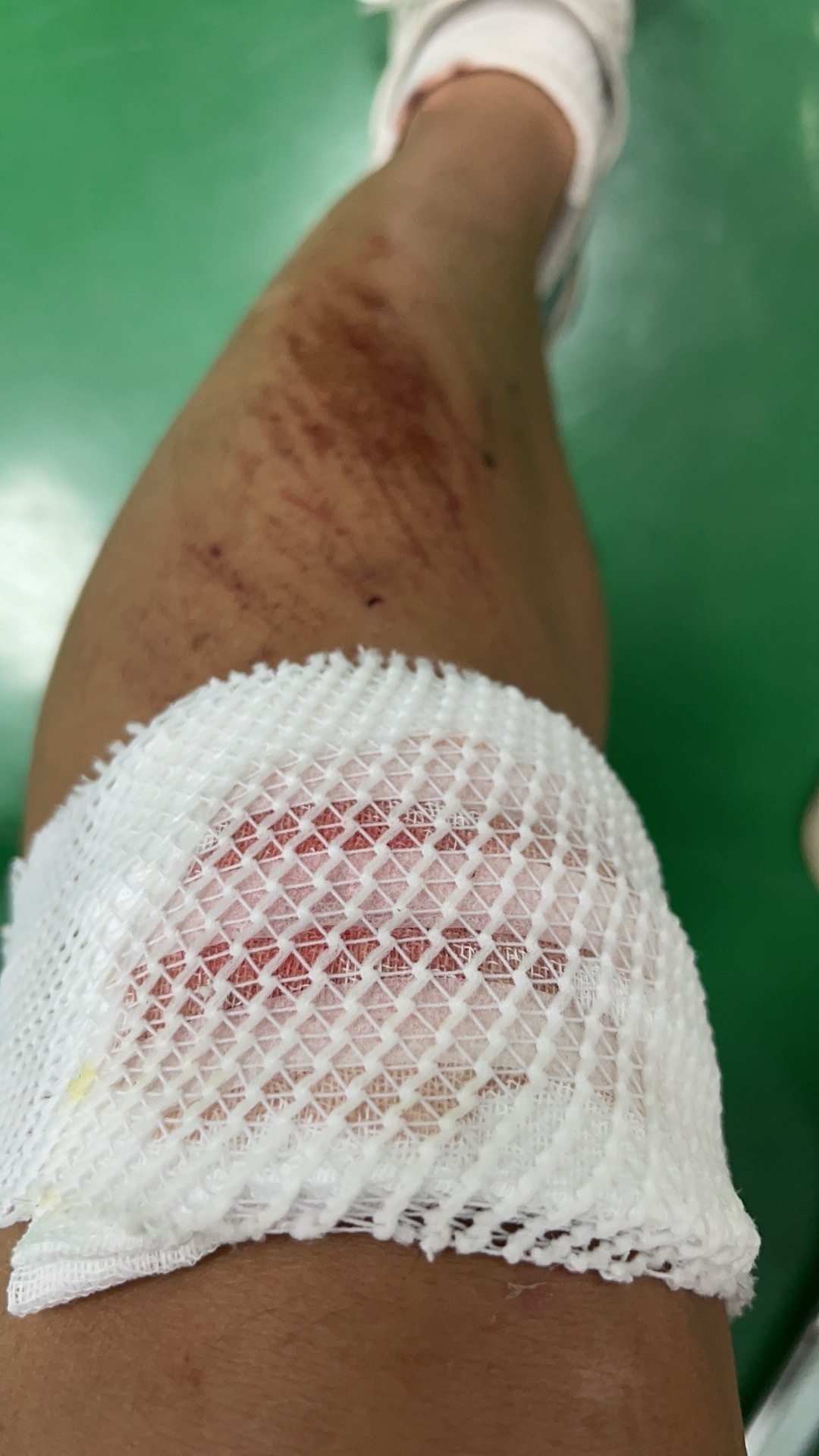 1712460079370031.jpg 7.范亮在抓捕过程不慎受伤,到医院处理伤口后照片.jpg