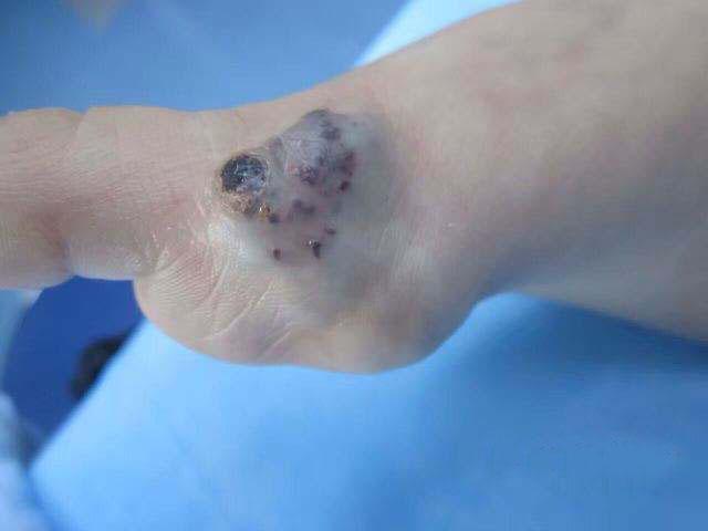 什么是静脉畸形血管瘤2000宝妈前来咨询答案